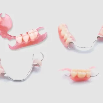 four example of partial dentures, one as small as a three tooth denture, three have metal fasteners that attach to existing natural teeth