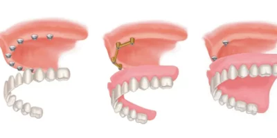 comparison of three major types of implant supported dentures. Snap in Dentures with gums that snap on to mini dental implants, an overdenture with gums that is fastened to a titanium bar that is in turn affixed to dental implants, and lastly a zirconia dental arch that has no false gums that is fastened directly to dental implants
