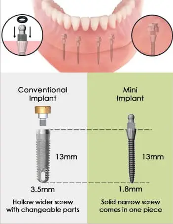 drawing with measurements showing conventional dental implant with abutment and thicker 3.5 mm diameter screw compared to mini implant and skinner 1.8 mm diameter screw