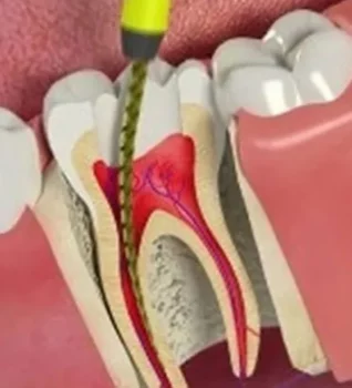 Image showing a root canal -- a dental excavator cleaning out the root of a cutaway tooth to demonstrate how it cleans to the bottom of the root