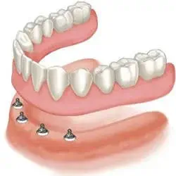 drawing showing a full arch bottom overdenture above four mini dental implants implanted into a lower jaw