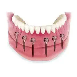 drawing of a full arch overdenture snapped into six mini dental implants