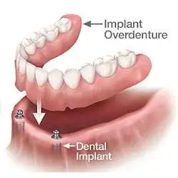 a snap-on implant overdenture above two mini dentali implants with arrow pointing downward to demonstrate snapping of denture.