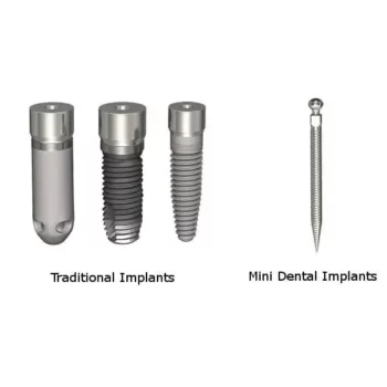 drawing with four different types of individual dental implant hardware --- three styles that are thicker and represent traditional dental implants, and one skinny mini dental implant