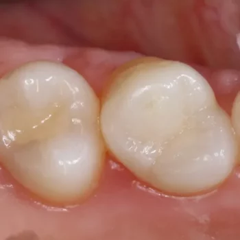 Example of two white / tooth color composite fillings placed on two molars