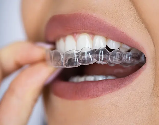 Custom Mouth Guard for Sports
