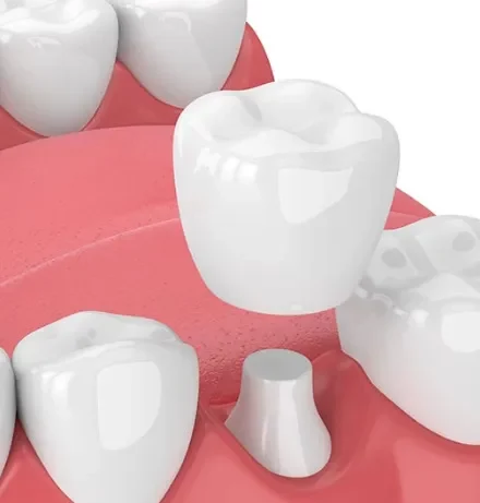 white ceramic porcelain crown, being placed on a natural tooth that has been reduced to an abutment