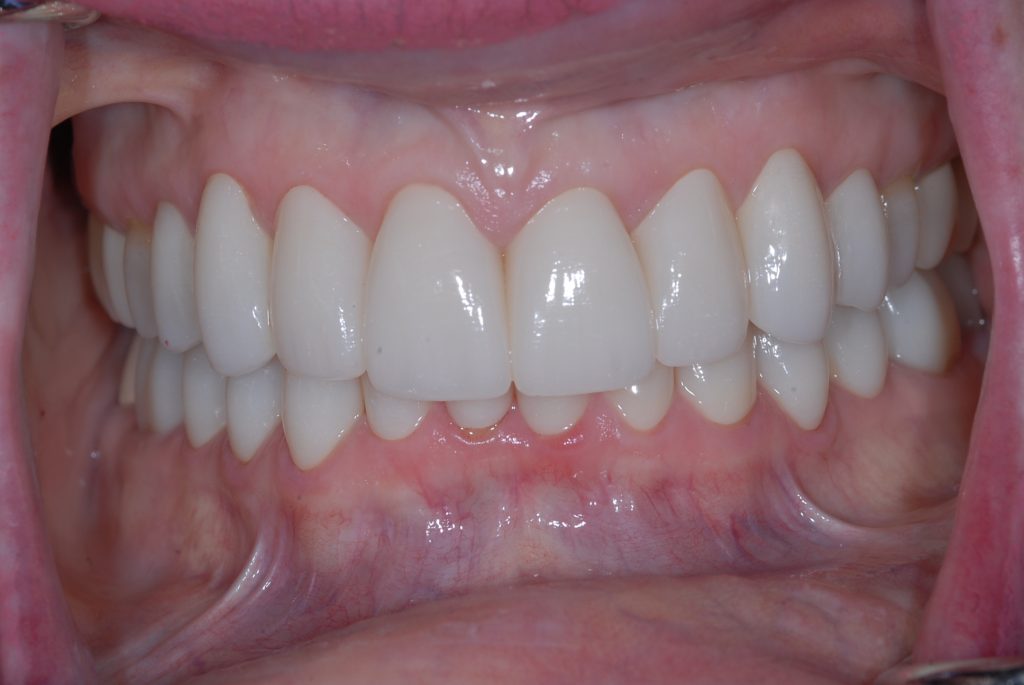 Nancy N. after procedure
